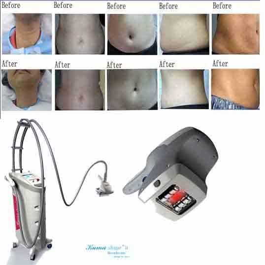 Kuma shape &  Velashape & LPG cellulite reduction machine on Sale 4