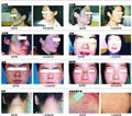 Q SWITCH Nd:YAG Laser Equipment Skin Care system Sincoheren 2