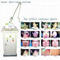 Q SWITCH Nd:YAG Laser Equipment Skin Care system Sincoheren 3