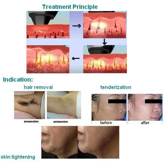 Medical CE approved high power 808nm Diode laser similar like lightsheer 4