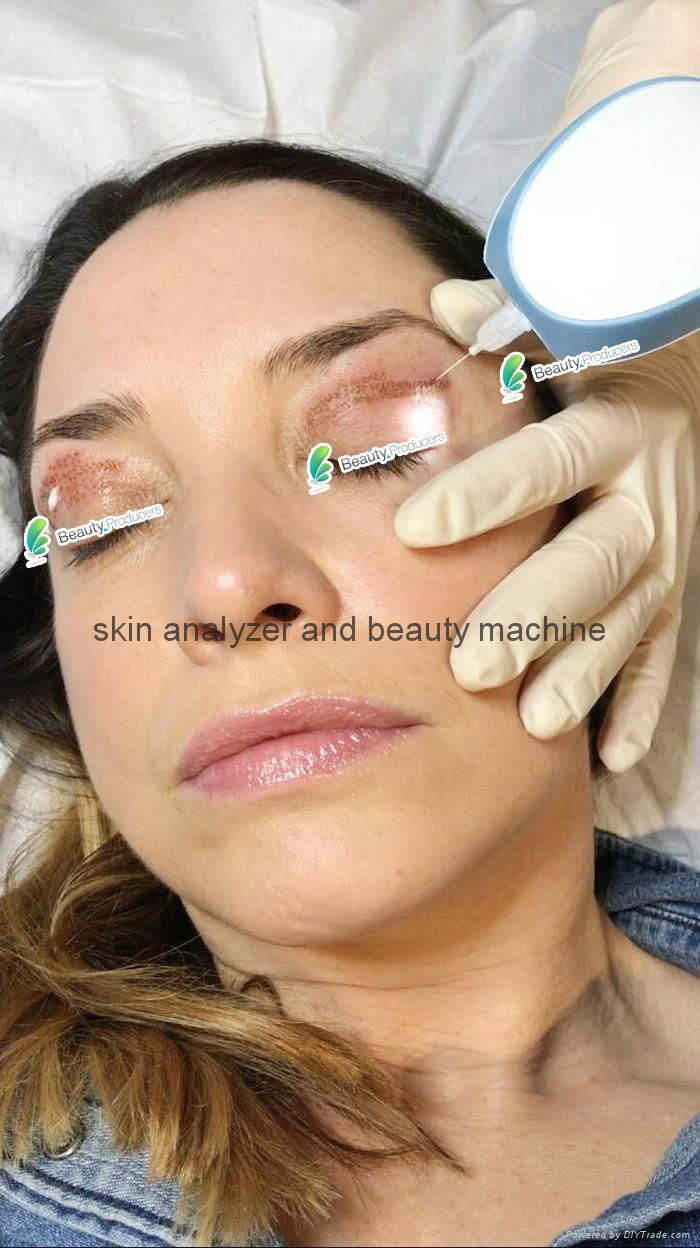 Plasma eye lift pen and spot removal machine without surgery