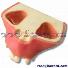 【Taiwan HANNRU- HR】Dental model PIM-13 Sinus Lift Implant Insertion