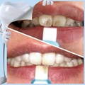 More Safe than Denture Cleaning Tablets Tooth Whitening 3