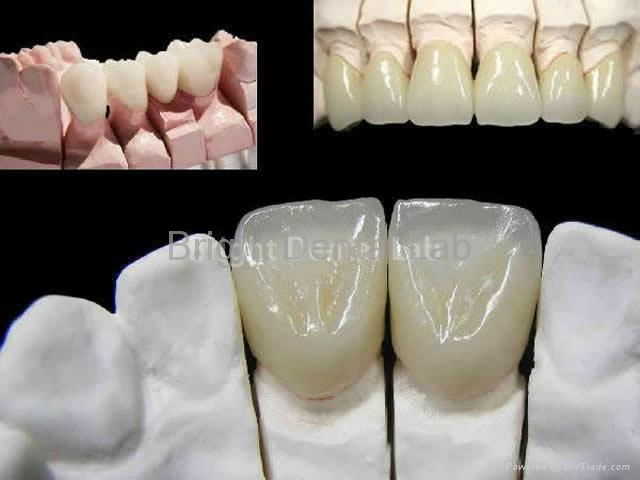 Dental PFM(Porcelain fused to metal) crowns and bridges 2