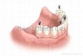 Dental Implant dentures
