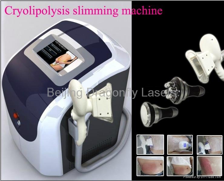 effective result cryolipolysis cavitation vacuum rf for fast body weight loss