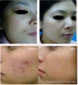 Er:yag laser 2940nm 5