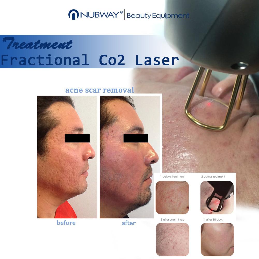 Latest medical 40W RF Tube fractional co2 laser with CE certification 4