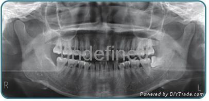 Digital OPG Dental Panoramic X-ray Machine 3