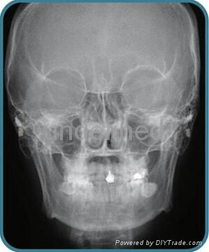Digital OPG Dental Panoramic X-ray Machine 4