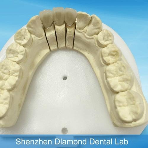 Denture supplier supplies Porcelain bonded to metal crown and bridge 