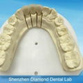 Denture supplier supplies Porcelain