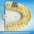 Dental Full metal crown/FCC Denture supplier 4