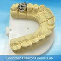 Dental Full metal crown/FCC Denture supplier 3