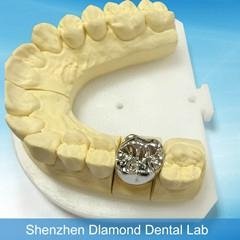 Dental Full metal crown/FCC Denture supplier 2