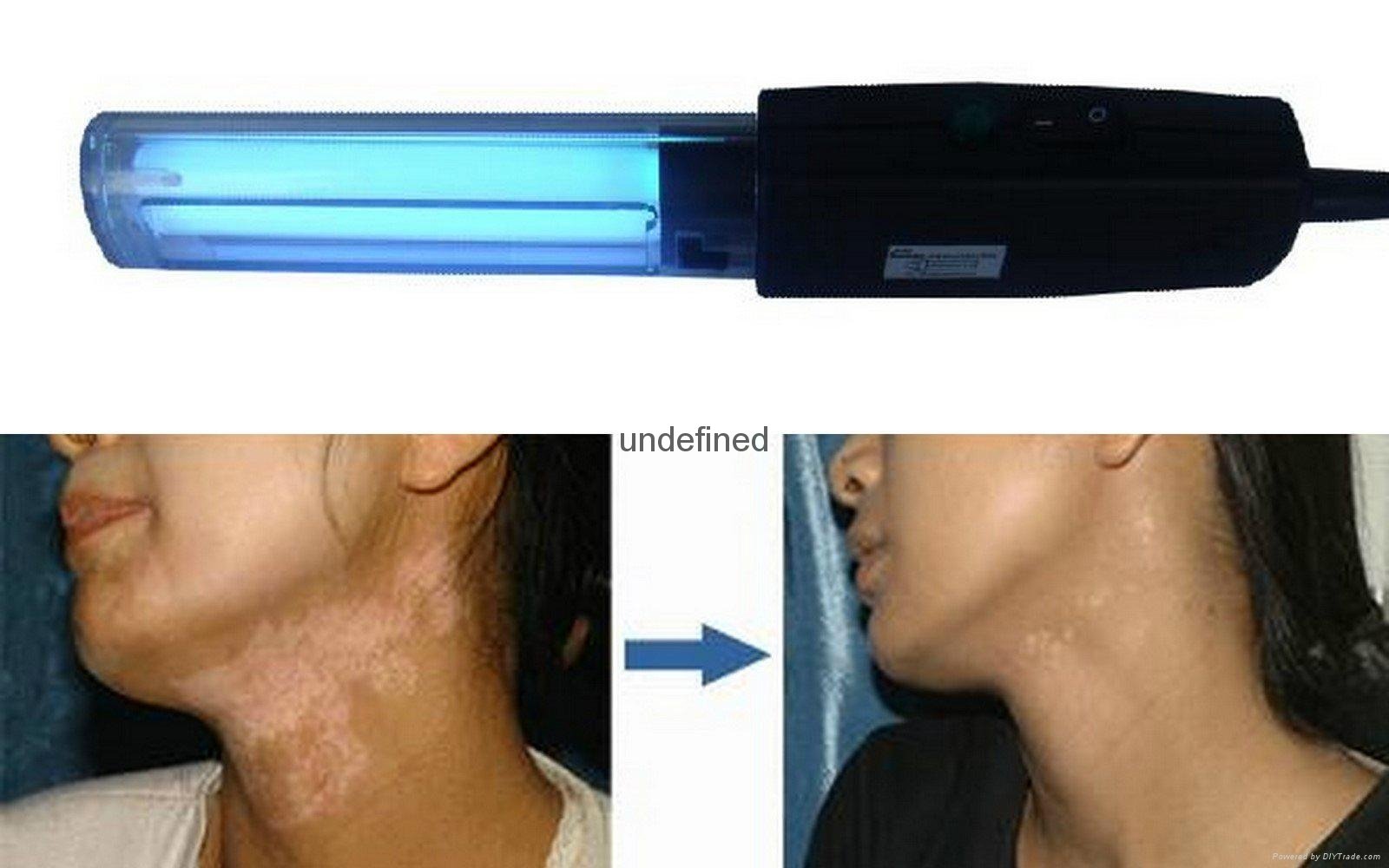 311nm narrow band uvb lamp for vitiligo treatment 5