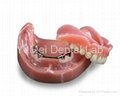 Denture with Milling Bar