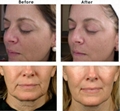 FU4.5-2S face lift skin tighten high