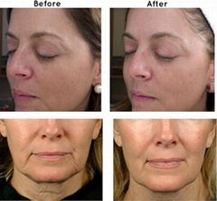 FU4.5-2S face lift skin tighten high