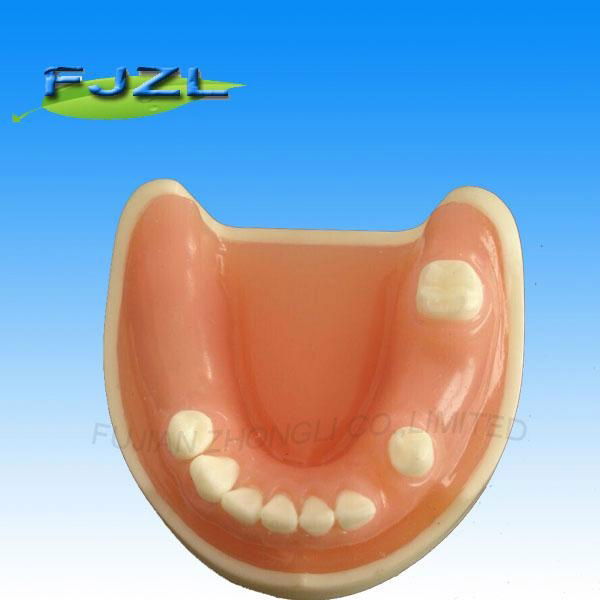 medical science dental implant model with soft gingiva 2