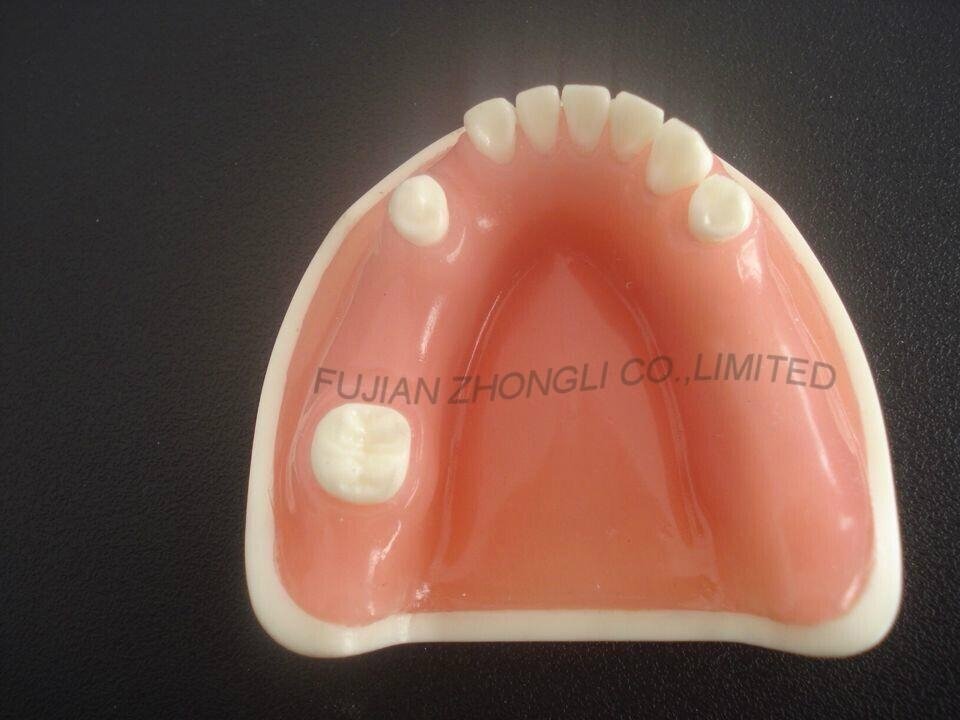 medical science dental implant model with soft gingiva 3