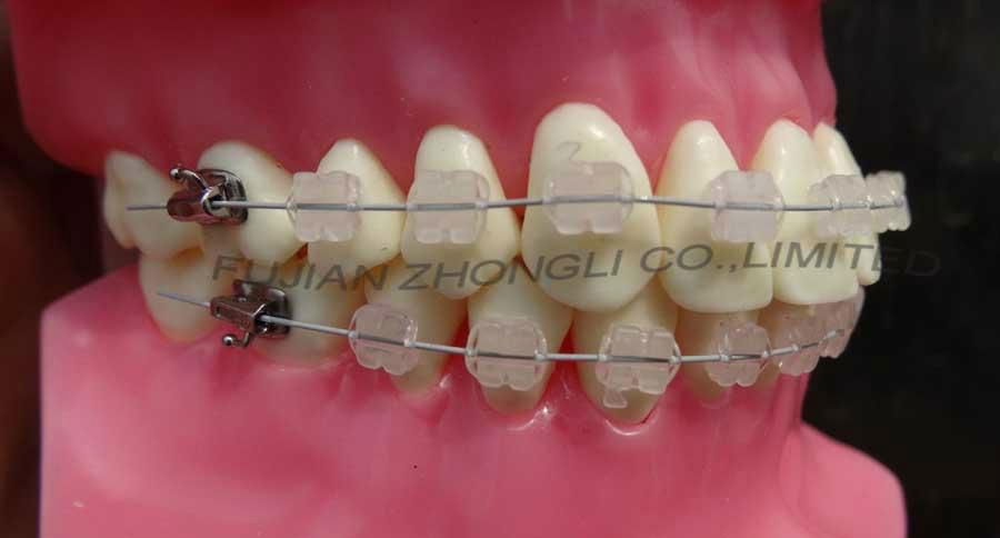 Orthodontic Teeth Model 2