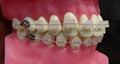 Orthodontic Teeth Model 2