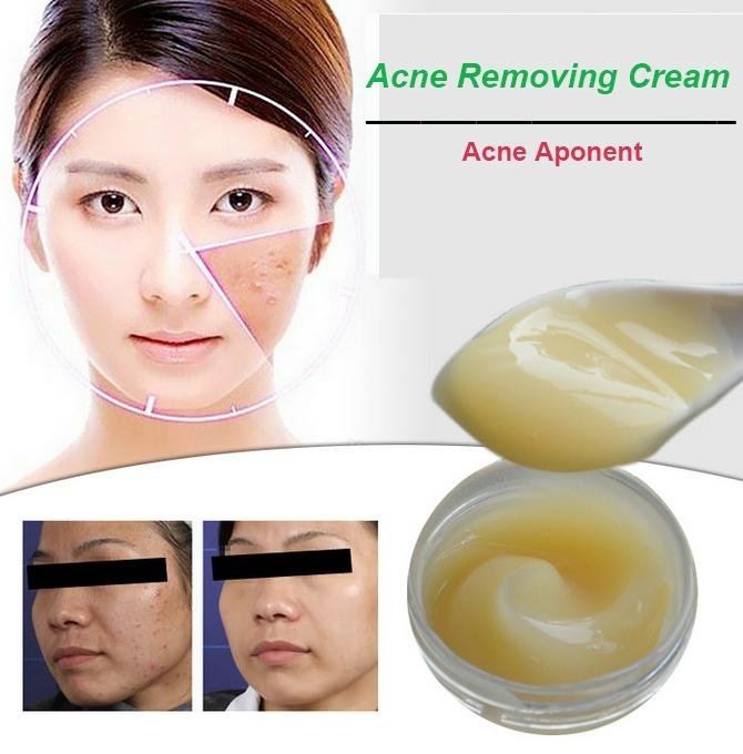 Acne Removing Cream 2