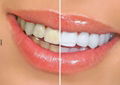 Night use teeth whitening strips  4