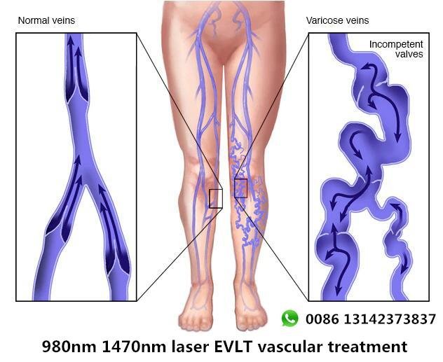 980nm 1470nm surgical liposuction diode laser EVLT PLDD treatment Proctology 3