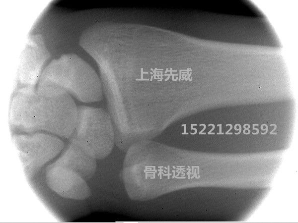 厂家最低直销2016新款特卖医用手提式X光机50mm报价 2