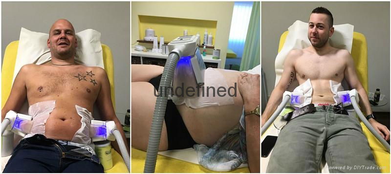 5 handles cryolipolysis slimming machine with cavitation Rf handles 3