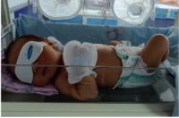 Protective eye-pads for new born during Jaundice phototherapy