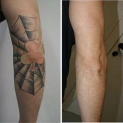 Q-Switch ND: YAG Tattoo Removal Laser