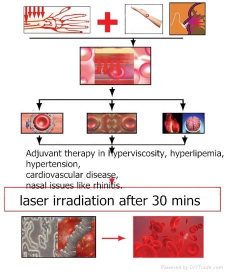 Cold laser 650nm therapy reducing hypertension 3
