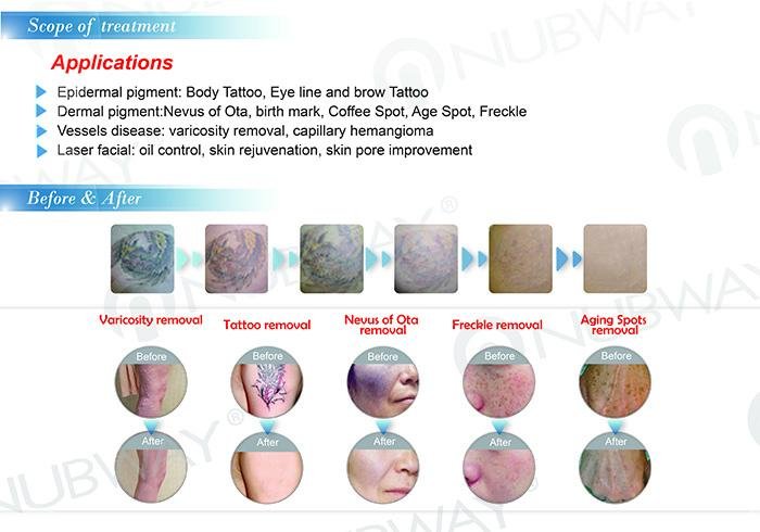 Professional Q-switched nd:yag laser for tattoo and pigmentation removal 4