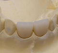 Dental porcelain teeth  1