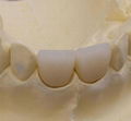 Dental porcelain teeth 