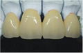 Dental Alloy Ceramic teeth 1