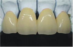 Dental Alloy Ceramic teeth