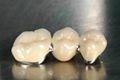 Dental ceramic teeth