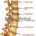 New design FYZ9800 Alien Capsule Non-surgical Spinal Decompression System