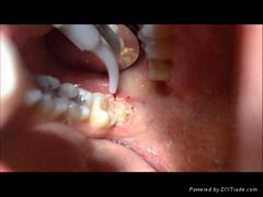 Dental Laser For Epulis Ablation