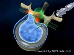 laser for spinal disc decompression less invasive
