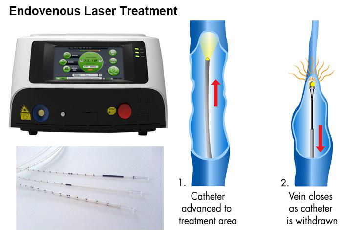 EVLT Surgery Vascular Vein Surgery 1470nm Laser