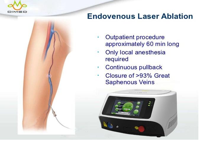 Laser Leg Vein Treatment Endovascular Laser Ablation