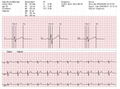 Home-Care 3 Leads ECG Event Recorder 5