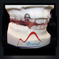 Frankel orthodontic dental Appliance