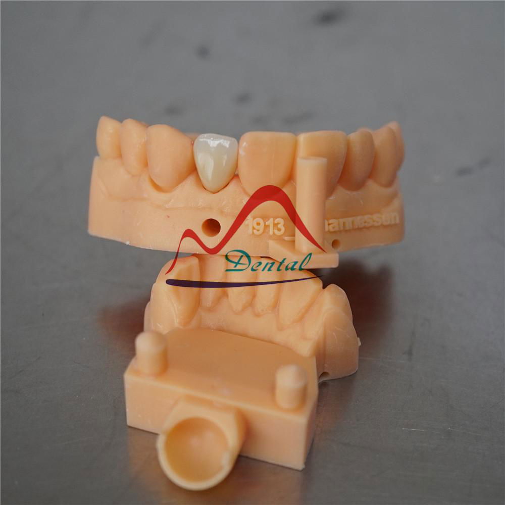 3Shape Digital Dental E-max Crown 5