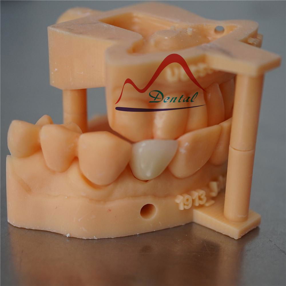 3Shape Digital Dental E-max Crown 4